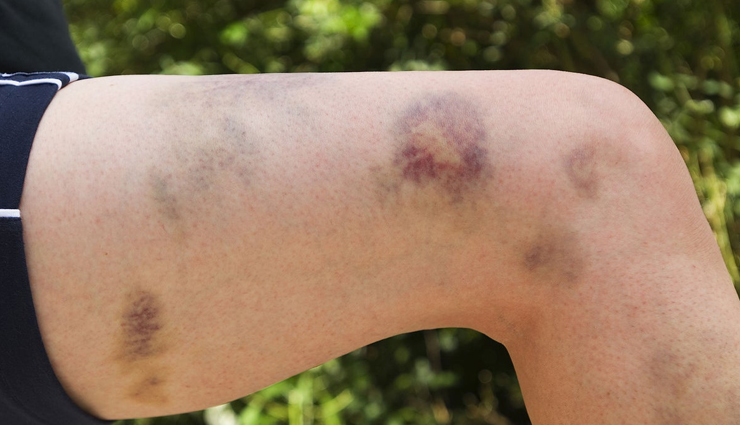 8 Remedies To Treat  Symptoms of Thrombocytopenia Naturally