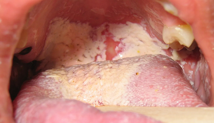 common mouth problems,tongue issues,dental hygiene,oral health concerns,mouth and tongue conditions,dental caries prevention,periodontal disease prevention,amalgam tattoo,halitosis treatment,black hairy tongue causes,canker sore remedies,tooth decay prevention,tooth abscess treatment,cold sore management,chipped tooth repair,leukoplakia diagnosis,lichen planus symptoms,thrush treatment,oral cancer detection,dry mouth remedies