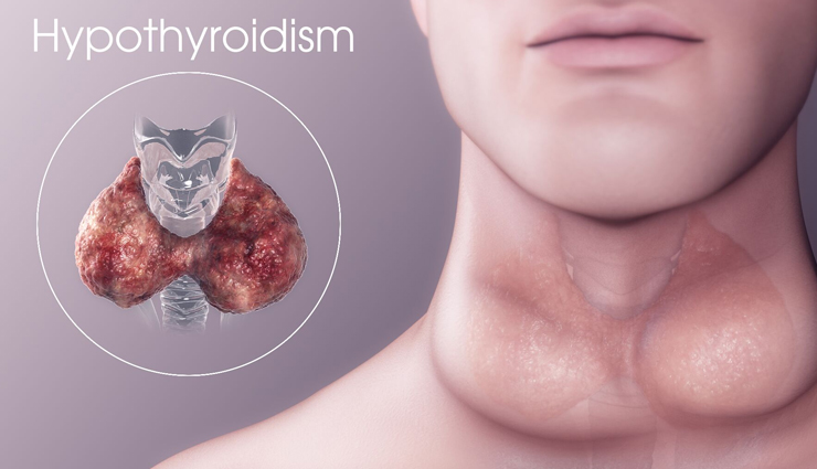 world thyroid day,types of thyroid,Health tips,fitness tips,hypothyroidism,hyperthyroidism