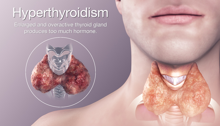 world thyroid day,types of thyroid,Health tips,fitness tips,hypothyroidism,hyperthyroidism