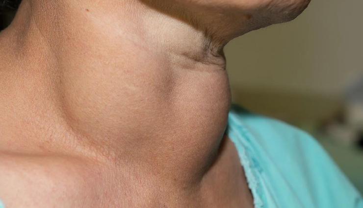 9 Major Causes and Symptoms of Thyroid