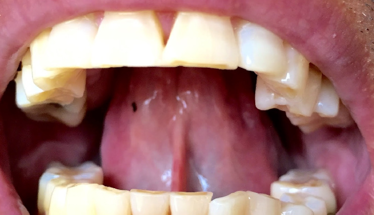 hiccups home remedies,how to stop hiccups,natural hiccups treatment,remedies for singultus,quick hiccup cure,prevent hiccups,diaphragm contractions,stop hiccup reflex,chronic hiccups solutions,persistent hiccups relief