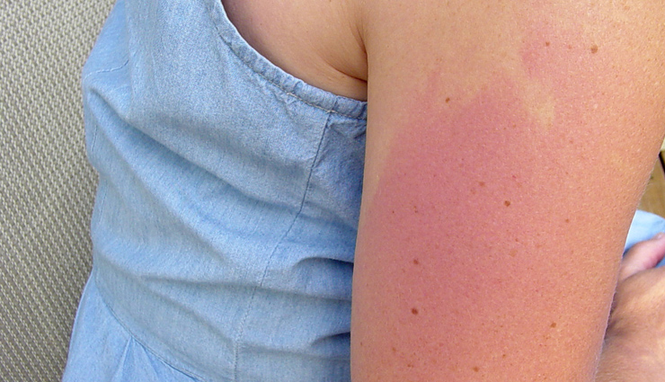 causes of rash on the back,back rash explanations,understanding back rash triggers,what causing my back rash?,back rash symptoms and causes,common reasons for back rash,identifying the rash on your back,treating rashes on the back,back rash diagnosis and treatment,managing back rash discomfort