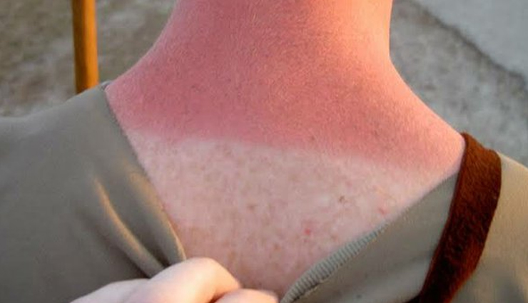 sunburn remedies,skincare,sunburn treatment,skin care after sun exposure,things to avoid after sunburn,sun protection,summer skincare,natural remedies,sunburn prevention,skin damage