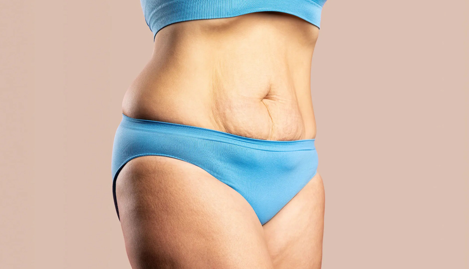 5 Steps That Help To Tighten Skin Post Weight Loss