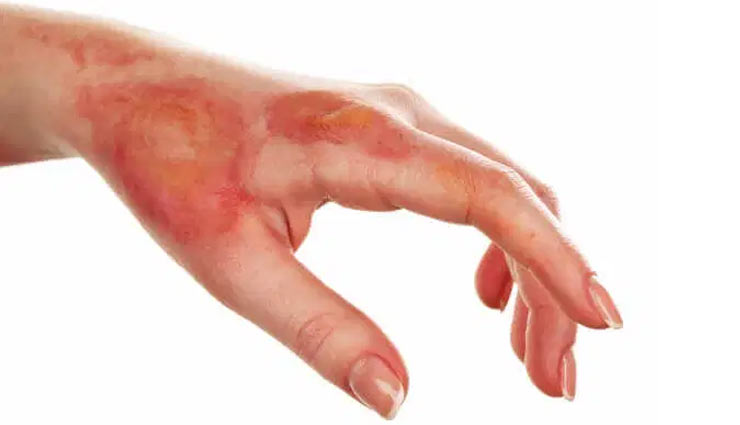 ways to treat minor burns,home remedies,home remedies for minor burns,burns treatment at home,Health tips,fitness tips