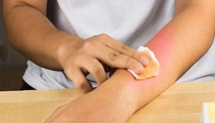 ways to treat minor burns,home remedies,home remedies for minor burns,burns treatment at home,Health tips,fitness tips