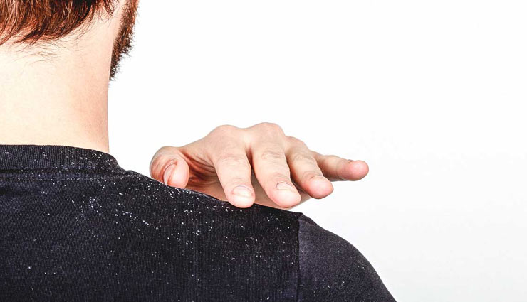 tips to get rid of dandruff,instant ways to get rid of dandruff,home remedies to get rid of dandruff,hair care tips,beauty tips