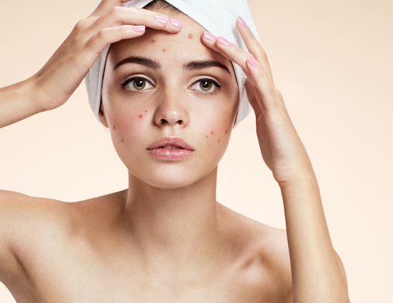 5 Ways To Treat Acne Naturally