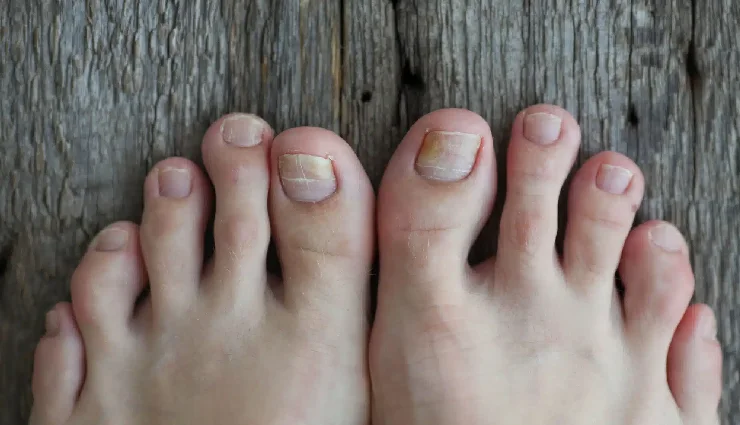 6 Natural Ways To Prevent Toenail Fungus