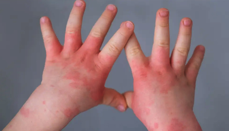 टोमैटो फ्लू ने बढ़ाई टेंशन, 5 साल से कम उम्र के बच्चों को ले रहा गिरफ्त में, देखें लक्षण और बचाव के तरीके tomato flu,tomato flu symptoms,tomato flu prevention,what is tomato flu,tomato flu fever,Health,health news,healthy living