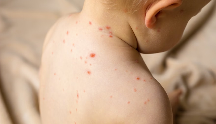 what is tomato flu,who is at risk of tomato flu,symptoms of tomato flu,causes of tomato flu,tomato flu treatment,health news,healthy living