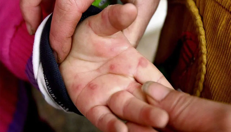 भारत में तेजी से फैल रहा Tomato Fever, अब तक मिले 82 मरीज; जानें क्या हैं लक्षण?