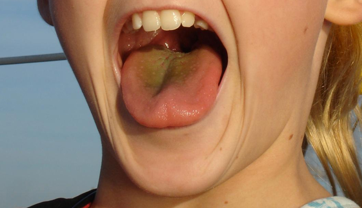 diseases associated with tongue color,different tongue color,Health tips,fitness tips