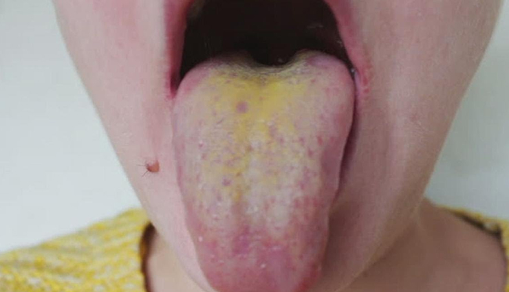 types of diseases that are reflected with tongue color,tongue color,Health tips,fitness tips