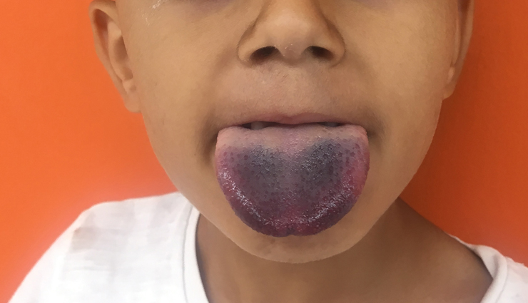 types of diseases that are reflected with tongue color,tongue color,Health tips,fitness tips