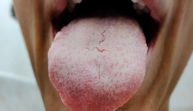 health from color of tongue,Health tips,fitness tips