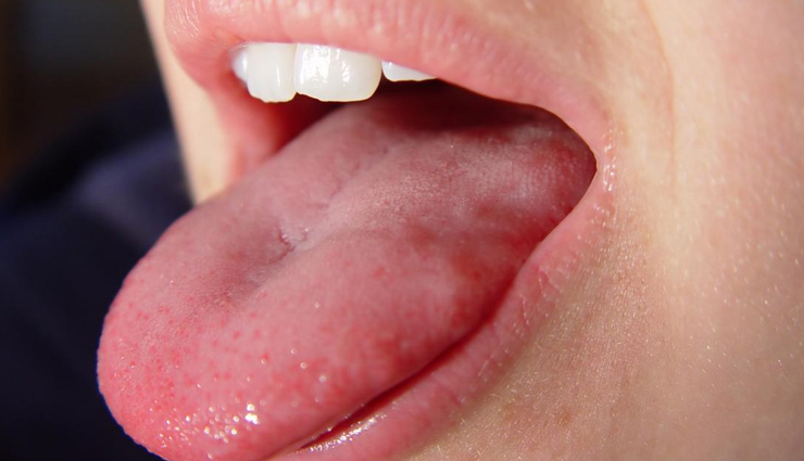 types of diseases that are reflected with tongue color,tongue color,Health tips,fitness tips