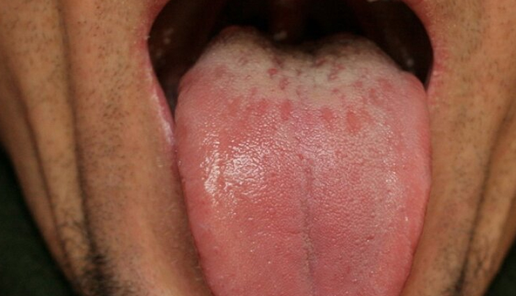 diseases associated with tongue color,different tongue color,Health tips,fitness tips
