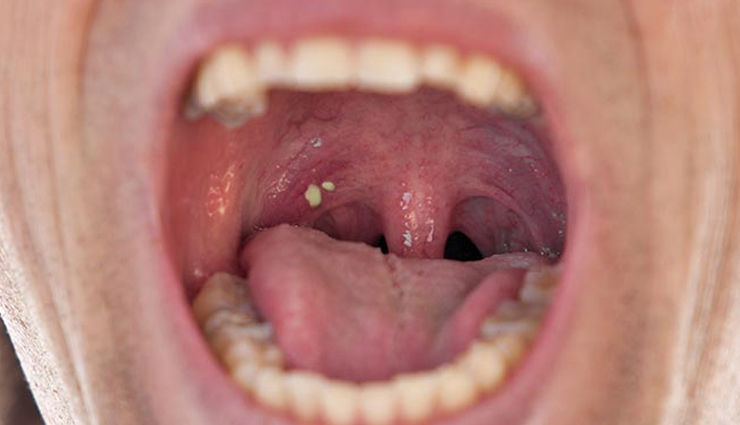 10 Natural Remedies For Tonsil Stones Treatment