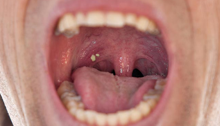 10 Natural Remedies for Tonsil Stones Treatment