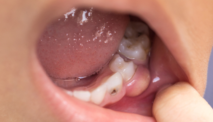 common mouth problems,tongue issues,dental hygiene,oral health concerns,mouth and tongue conditions,dental caries prevention,periodontal disease prevention,amalgam tattoo,halitosis treatment,black hairy tongue causes,canker sore remedies,tooth decay prevention,tooth abscess treatment,cold sore management,chipped tooth repair,leukoplakia diagnosis,lichen planus symptoms,thrush treatment,oral cancer detection,dry mouth remedies