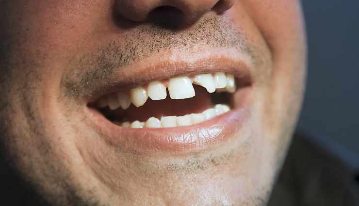 tooth pain,home remedies to get rid or tooth pain,tooth pain remedies,teeth pain remedy,cavities,broken tooth,teeth care tips,Health,Health tips