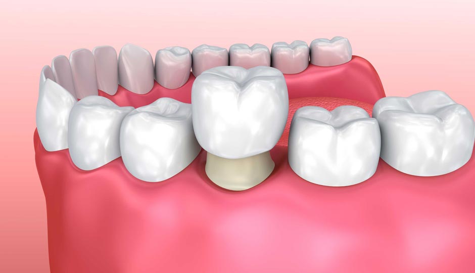 8 Home Remedies to Help Relieve Pain in a Tooth Cap