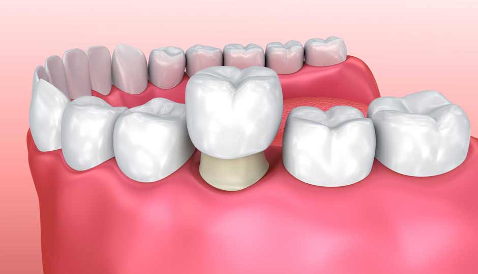 7 Home Remedies for Pain in a Tooth Cap