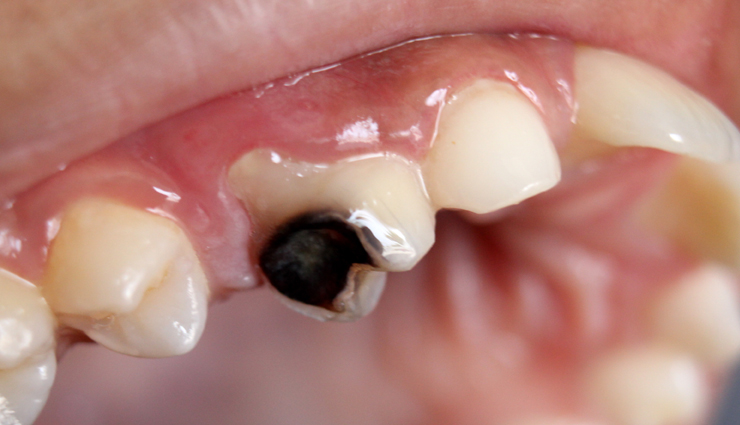 side effects of apple cider vinegar,risks of using apple cider vinegar,negative effects of apple cider vinegar,apple cider vinegar: potential side effects,health concerns of using apple cider vinegar,beware of apple cider vinegar side effects,apple cider vinegar usage and its drawbacks,is apple cider vinegar safe? side effects,adverse reactions to apple cider vinegar,apple cider vinegar: unwanted effects,possible consequences of apple cider vinegar use,health issues linked to apple cider vinegar,apple cider vinegar precautions and side effects,managing risks of apple cider vinegar,balancing benefits and risks: apple cider vinegar