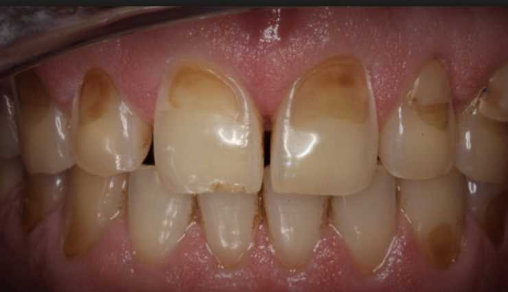 apple cider vinegar side effects,side effects of drinking too much apple cider vinegar,acv side effects on health,negative effects of excessive apple cider vinegar consumption,risks of drinking too much apple cider vinegar,apple cider vinegar drawbacks and side effects,health complications from excessive acv consumption,adverse effects of consuming large amounts of apple cider vinegar