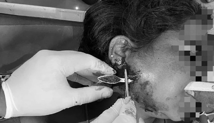 दांत साफ करते वक्त महिला बाथरूम में फिसली, गाल चीरकर निकालना पड़ा टूथब्रश