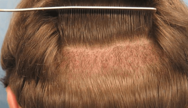 hair transplant myths,hair care tips,beauty tips