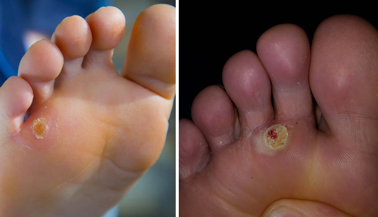 9 Effective Home Remedies To Treat Corns