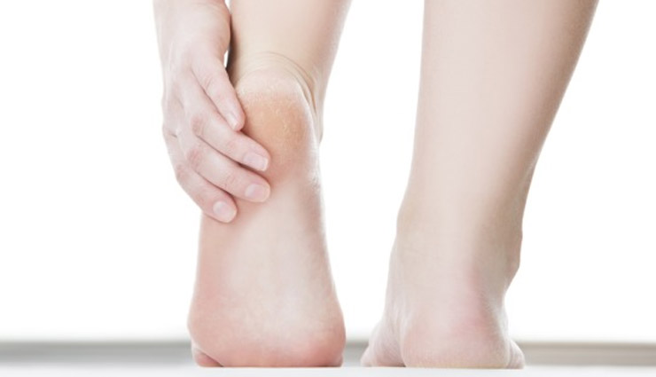 Holi Special- 5 Home Remedies To Treat Crack Heels