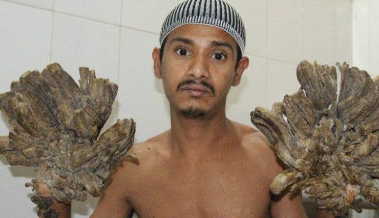 हाथ और पैर पर उग आती हैं पेड़ जैसी शाखाएं, दर्द से परेशान शख्‍स ने कहा - प्‍लीज, मेरे हाथ काट दो