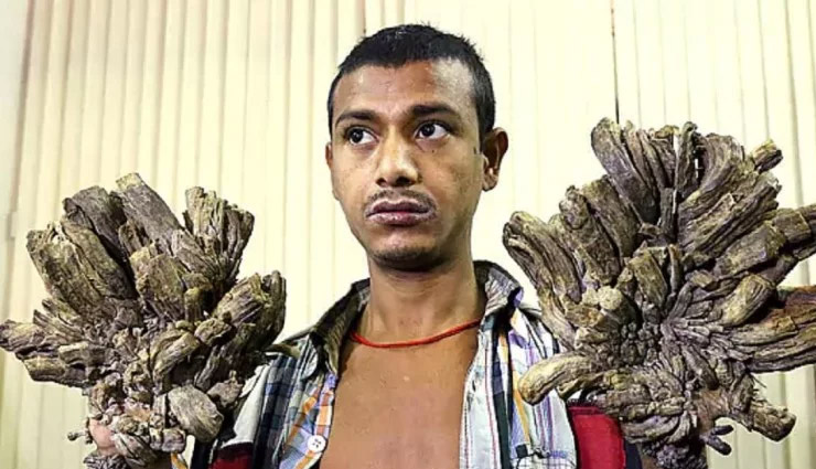 tree man,abul bajandar,bangladesh,weird story,weird news