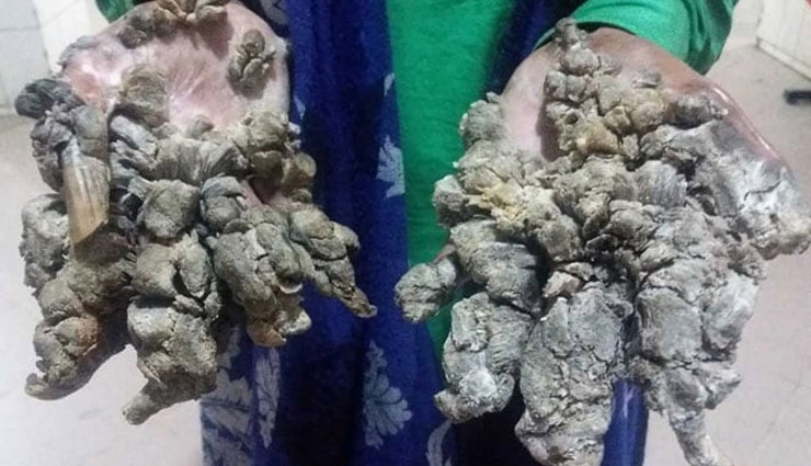 tree man,abul bajandar,bangladesh,weird story,weird news