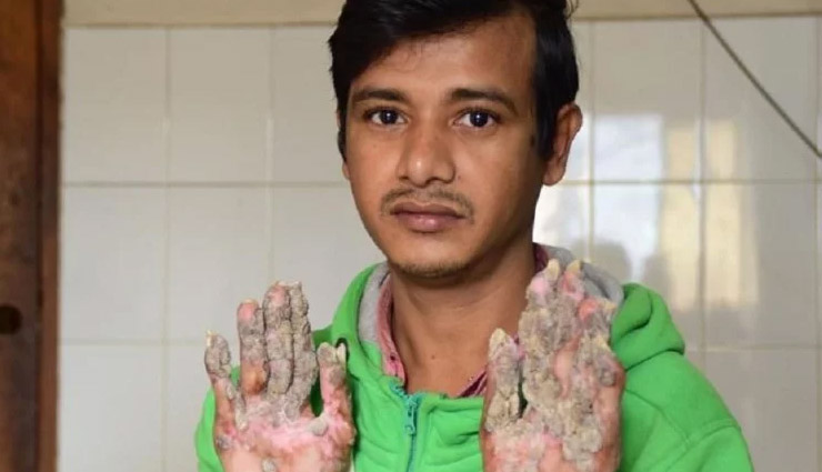 tree man,abul bajandar,bangladesh,weird story,weird news