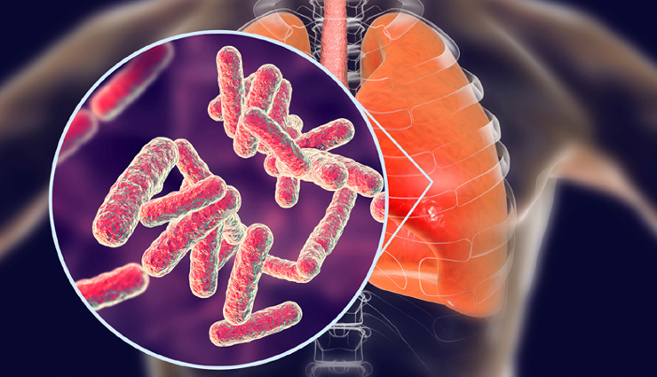 5 Natural Remedies To Treat Tuberculosis