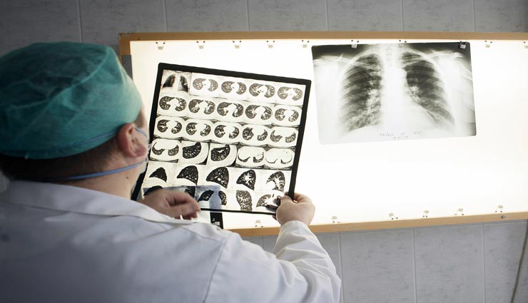 Health tips,health tips in hindi,health report,coronavirus,tuberculosis