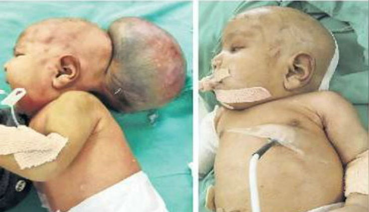 16 दिन की बच्ची के सिर में था 4 किलो का ट्यूमर, 5 घंटे की सर्जरी के बाद मिली नई जिंदगी