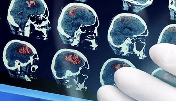 brain tumor signs,brain tumor symptoms,seizures from brain tumor,brain tumor and nausea,visual disturbances,memory loss brain tumor,brain tumor headaches,brain tumor diagnosis,benign brain tumors,malignant brain tumors