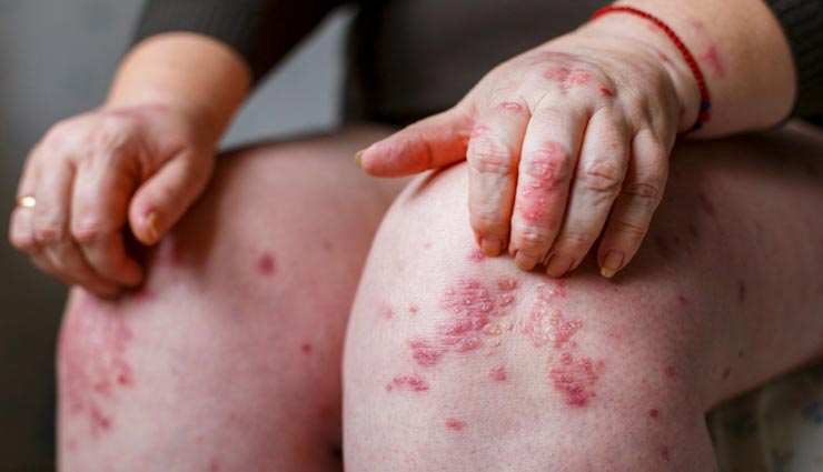 turmeric,beauty benefits of turmeric,skin care tips,beauty tips