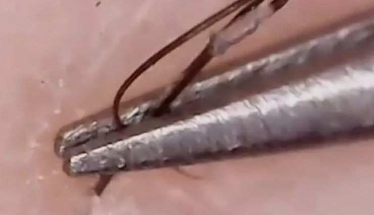 nipple hair removal,safe hair removal methods,effective hair removal techniques,shaving breast nipples,tweezing nipple hair,depilatory creams for nipple hair,laser hair removal for breast nipples,electrolysis for nipple hair,natural remedies for nipple hair removal,turmeric and milk paste for hair removal