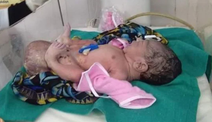 MP News: महिला ने दिया दो सिर वाली बच्ची को जन्म, डॉक्टर भी हैरान