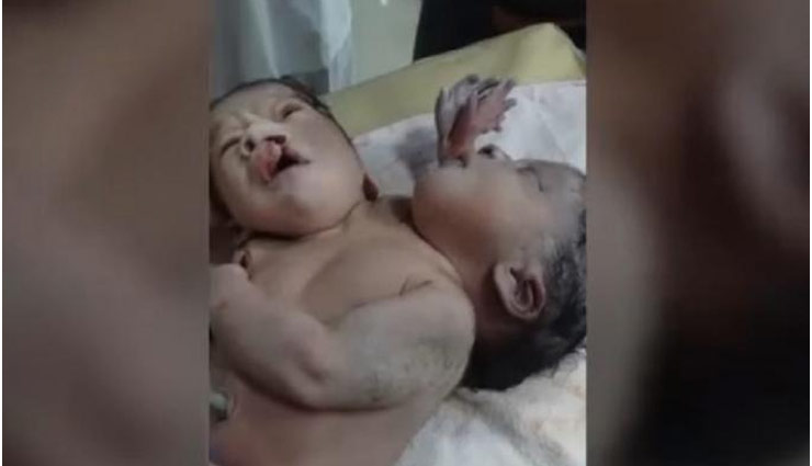 महिला ने दो सिर, तीन हाथ और चार पंजे वाले बच्चे को दिया जन्म, देख डॉक्टर के भी छुटे पसीने