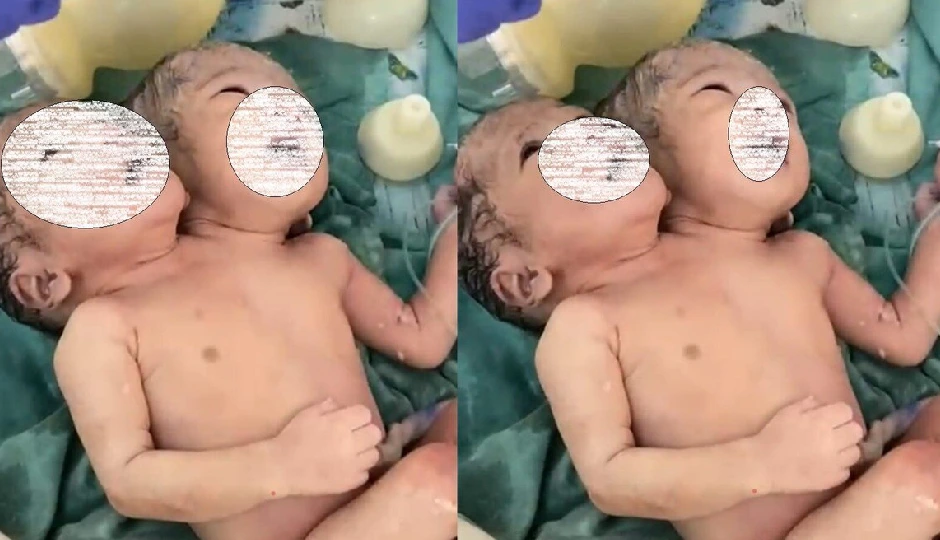 इंदौर में जन्मे दो सिर और एक शरीर वाले जुड़वा शिशु, डॉक्टर भी रह गए दंग