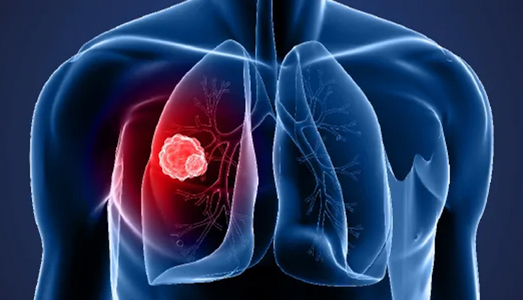 world cancer day common cancer types,10 most common cancers awareness,types of cancer to be aware of,common cancers on world cancer day,cancer prevalence and awareness,top 10 cancer types you should know,understanding common cancer varieties,global awareness of common cancers,key cancer types for awareness,world cancer day information on cancers,common cancer statistics and awareness,important cancers to be aware of,know the prevalence of common cancers,significance of knowing common cancer types,cancer awareness through common types,recognizing the 10 most prevalent cancers