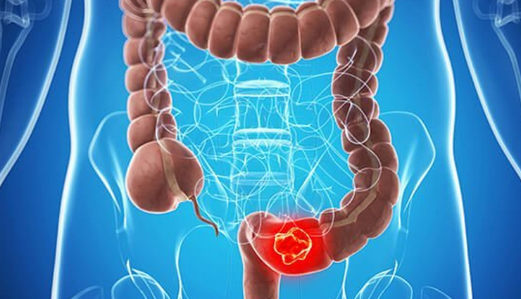 world cancer day common cancer types,10 most common cancers awareness,types of cancer to be aware of,common cancers on world cancer day,cancer prevalence and awareness,top 10 cancer types you should know,understanding common cancer varieties,global awareness of common cancers,key cancer types for awareness,world cancer day information on cancers,common cancer statistics and awareness,important cancers to be aware of,know the prevalence of common cancers,significance of knowing common cancer types,cancer awareness through common types,recognizing the 10 most prevalent cancers